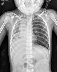 1常見食物！2歲童誤食「卡在氣管跳舞」緊急送醫　插管搶命「左肺全塌」醫搖頭了