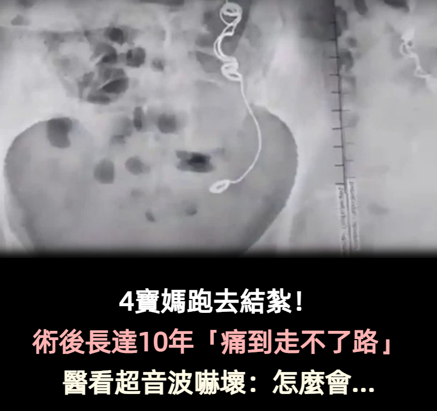 4寶媽跑去結紮！10年間「痛到走不了路」頻吃止痛藥　「超音波畫面曝光」醫生嚇壞：裡面有東西