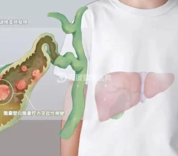 注意！醫師示警「這4種堅果」恐是膽息肉元凶：再愛吃也不行