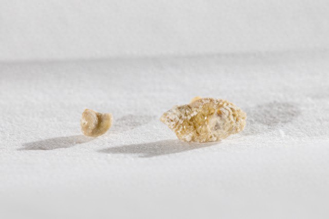 體內有結石 ，排尿就知道 ！醫生：排尿時「出現3個異常」已經在警告你了