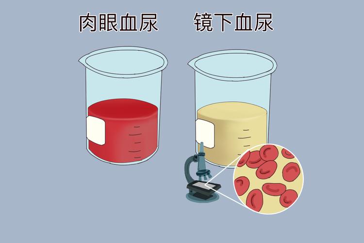 體內有結石 ，排尿就知道 ！醫生：排尿時「出現3個異常」已經在警告你了