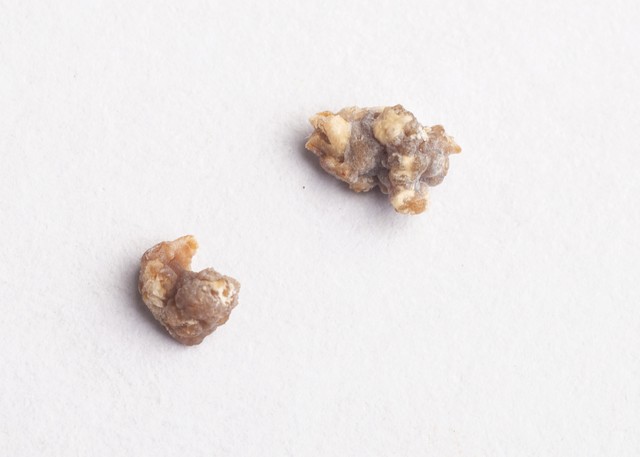 體內有結石 ，排尿就知道 ！醫生：排尿時「出現3個異常」已經在警告你了