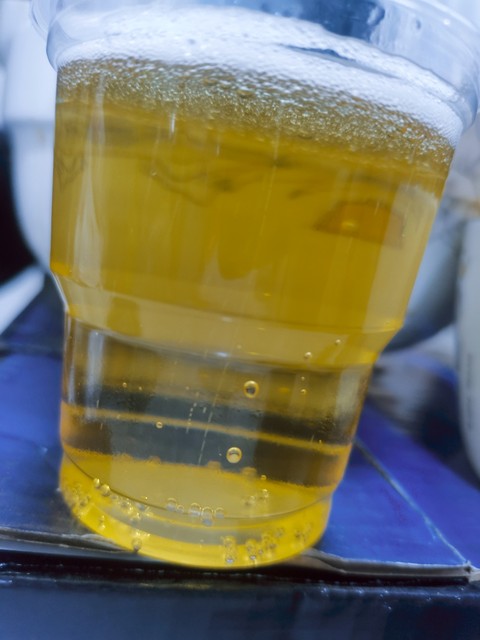 體內有結石 ，排尿就知道 ！醫生：排尿時「出現3個異常」已經在警告你了