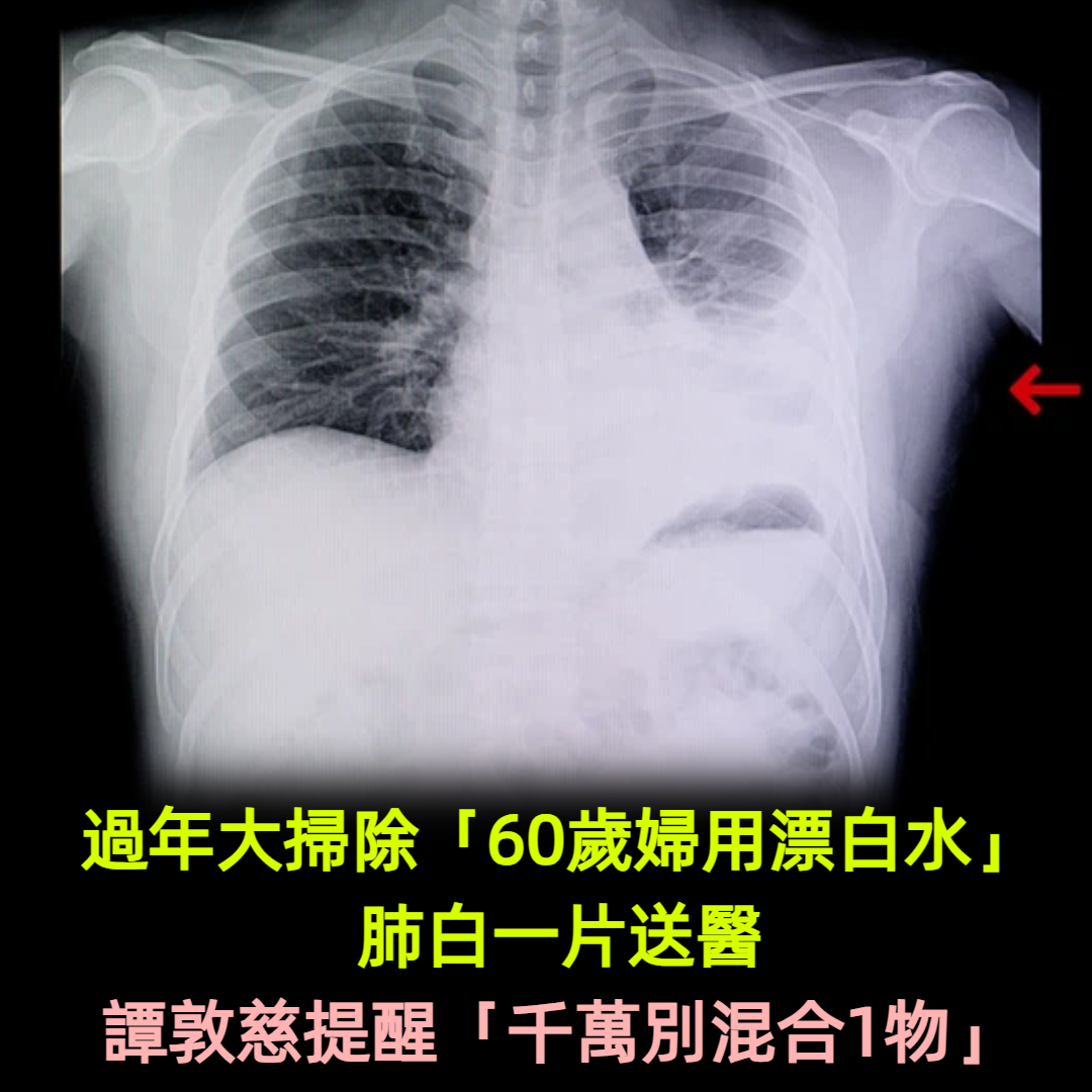 過年大掃除「60歲婦用漂白水」竟肺白一片送醫　譚敦慈提醒「千萬不要混和1物」