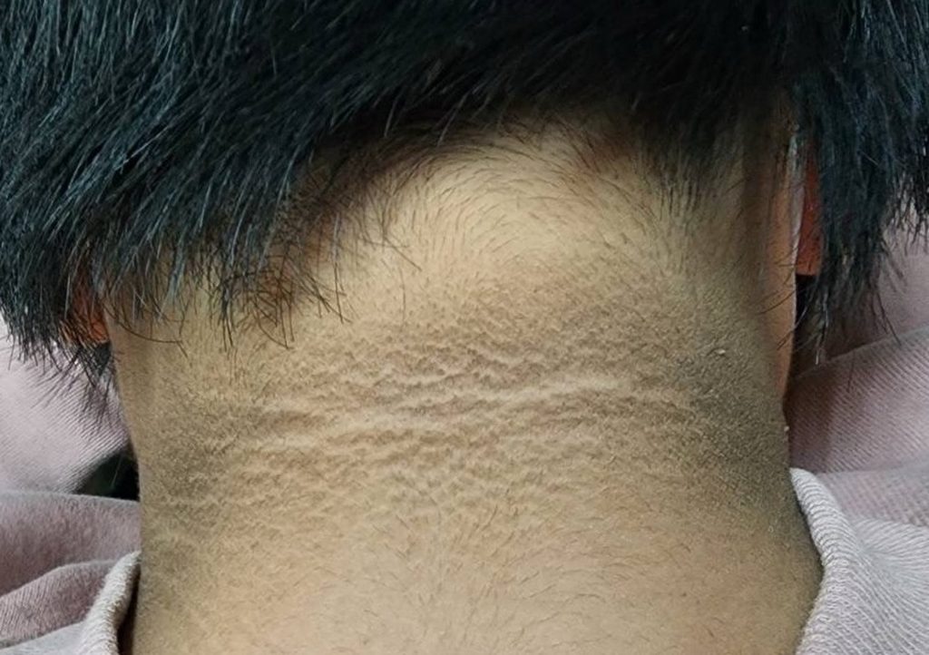 臉上7徵兆「恐是糖尿病」！醫示警：中3個快檢查