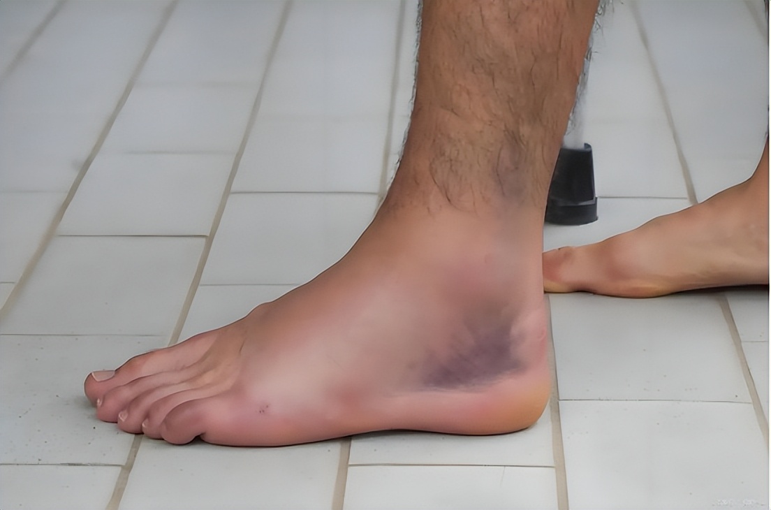 腎臟開始衰竭的信號！醫生認了「喝水後馬上出現」