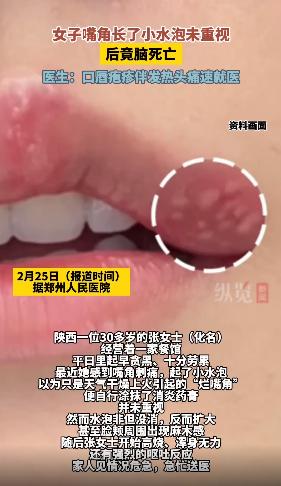 30歲女「嘴角長水泡」以為火氣大！自己買藥膏擦「1個月後腦死」　醫診斷「病因出爐」婆婆崩潰了
