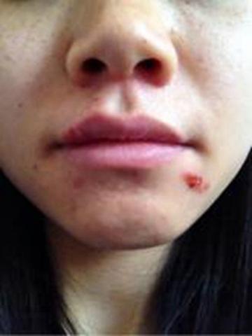 30歲女「嘴角長水泡」以為火氣大！自己買藥膏擦「1個月後腦死」　醫診斷「病因出爐」婆婆崩潰了