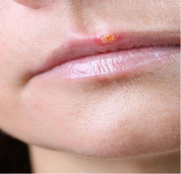 30歲女「嘴角長水泡」以為火氣大！自己買藥膏擦「1個月後腦死」　醫診斷「病因出爐」婆婆崩潰了