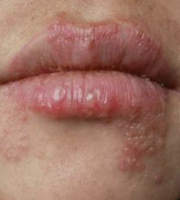 30歲女「嘴角長水泡」以為火氣大！自己買藥膏擦「1個月後腦死」　醫診斷「病因出爐」婆婆崩潰了