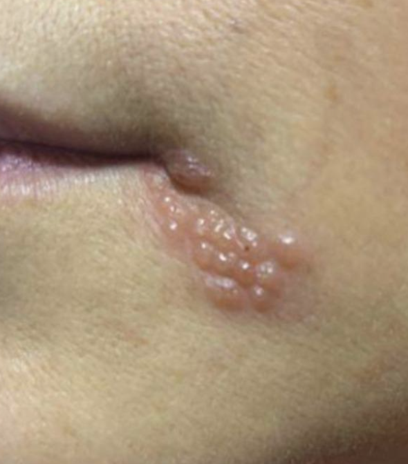 30歲女「嘴角長水泡」以為火氣大！自己買藥膏擦「1個月後腦死」　醫診斷「病因出爐」婆婆崩潰了