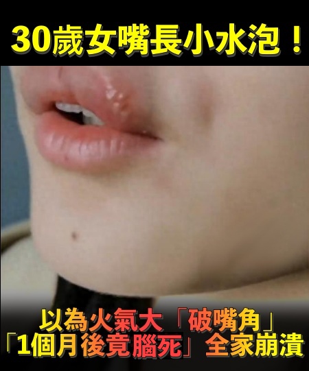 30歲女「嘴角長水泡」以為火氣大！自己買藥膏擦「1個月後腦死」　醫診斷「病因出爐」婆婆崩潰了
