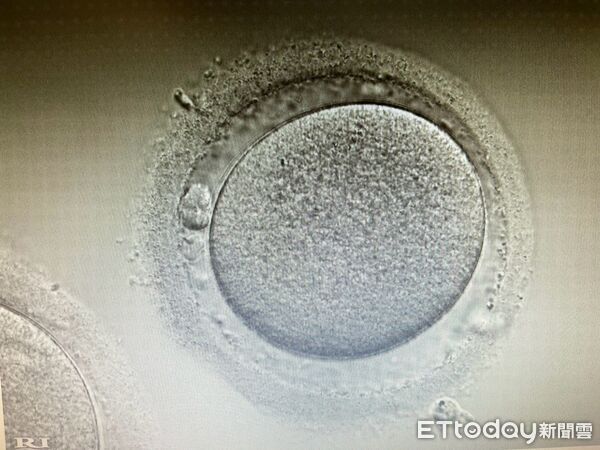 許維恩罹乳癌「胸部全切除」！醫示警6症狀「早期幾乎不痛」：很多人忽略