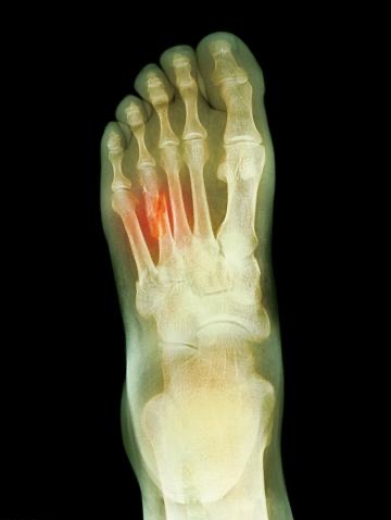 看似舒適其實比高跟鞋還傷！骨科醫師點名「5鞋款超傷腳」　長期慢性傷害「比骨折更難救」