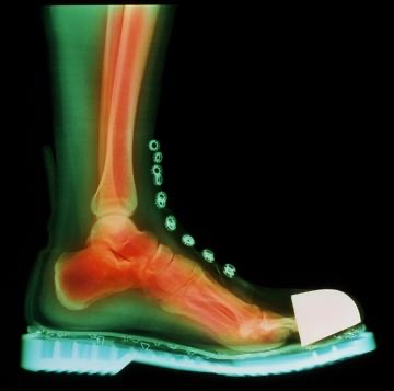 看似舒適其實比高跟鞋還傷！骨科醫師點名「5鞋款超傷腳」　長期慢性傷害「比骨折更難救」