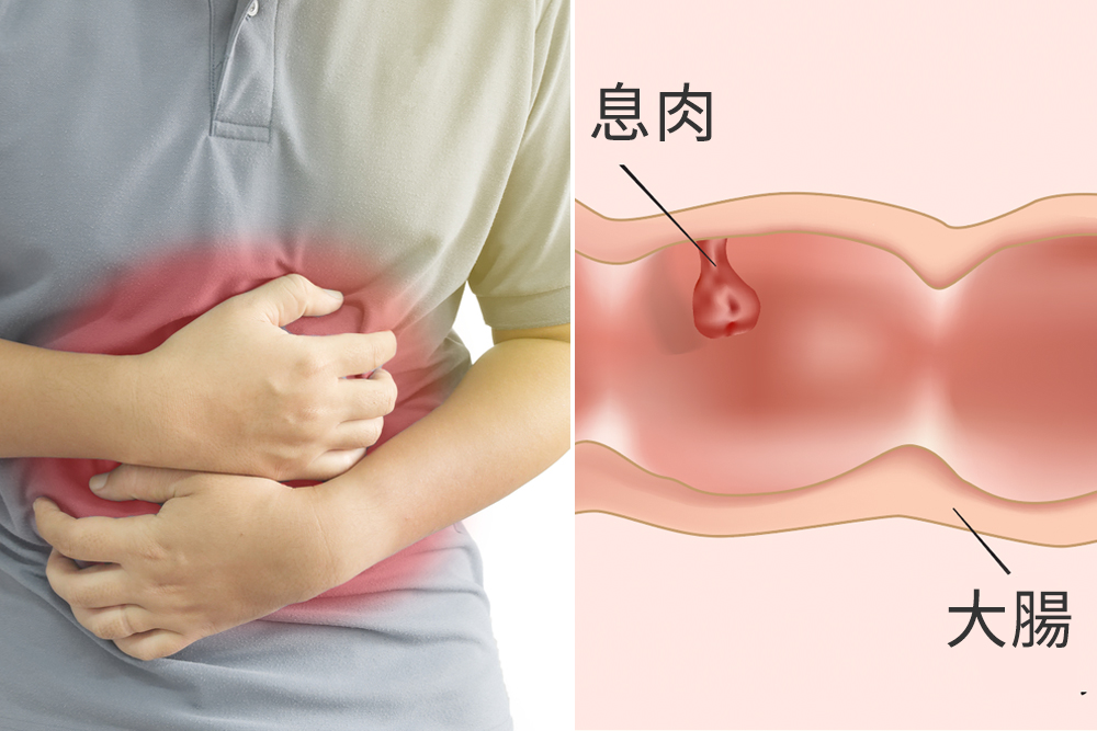 50歲經理被揪出「癌前病變」！「改吃1平民神菜」 3年後大腸超漂亮