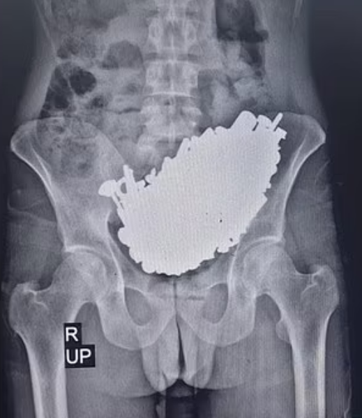 37歲男子腹痛就醫!醫生一照X光「發現超過3公斤...」:全部塞滿了