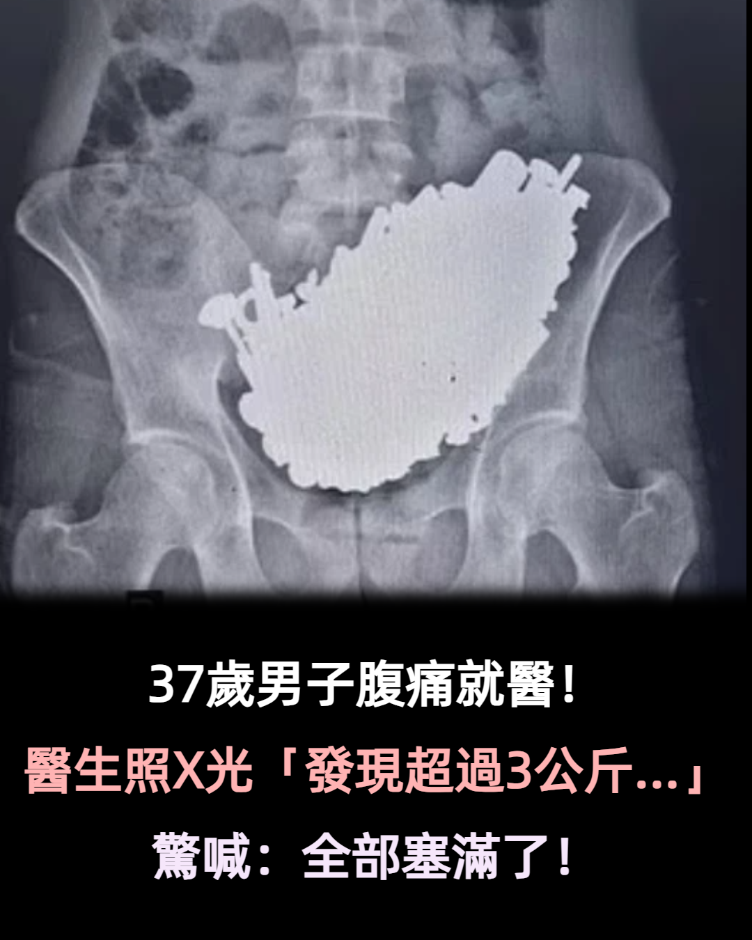 37歲男子腹痛就醫!醫生一照X光「發現超過3公斤...」:全部塞滿了