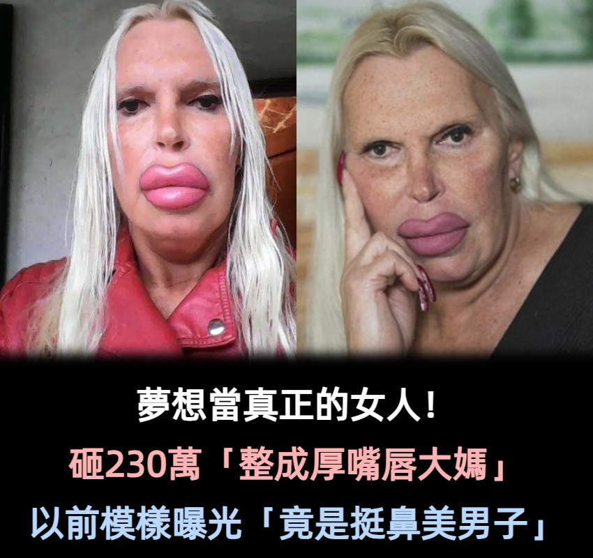 她砸230萬「整成厚嘴唇大媽」嚇壞全球！公開以前模樣「原本是挺鼻美男子」家人氣到不往來