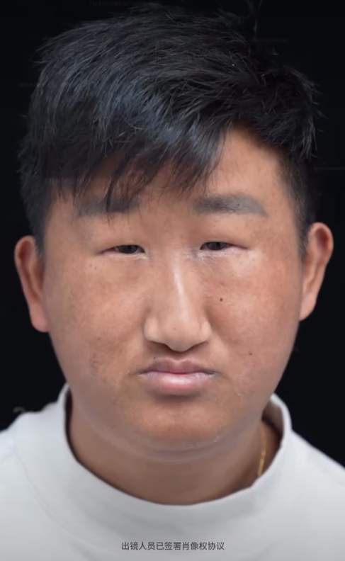 五官長超擠！他靠「超小眼睛」爆紅　下定決心「去動雙眼皮手術」成果網看呆：有差嗎