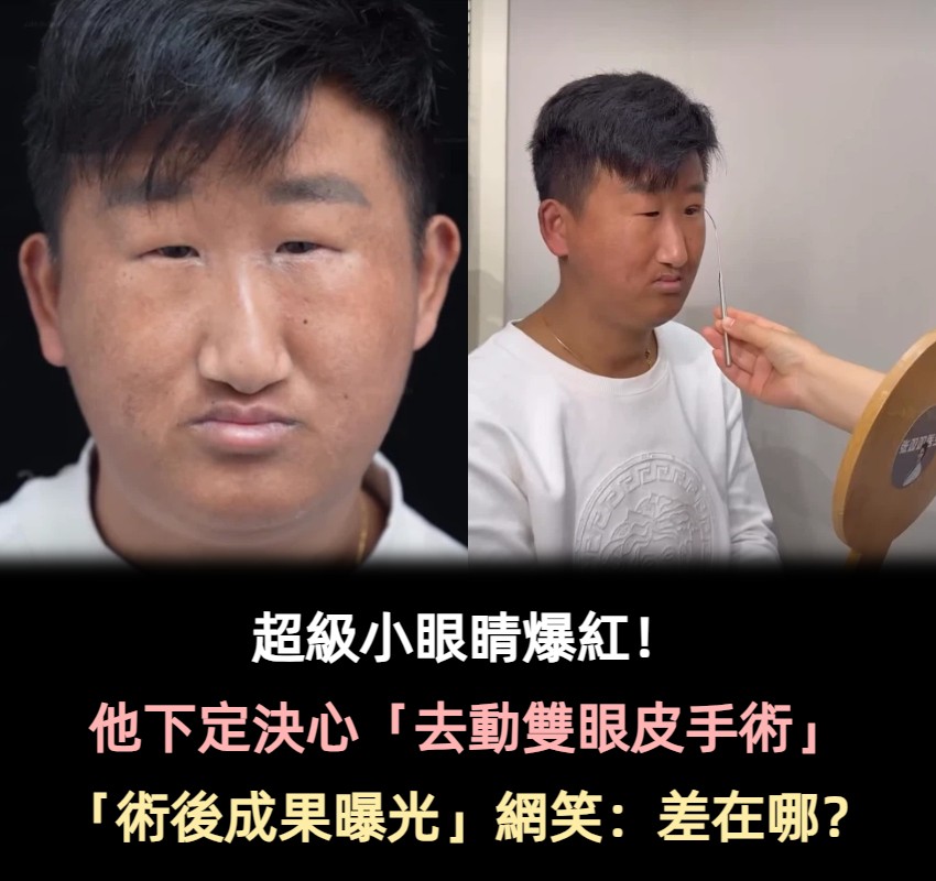 五官長超擠！他靠「超小眼睛」爆紅　下定決心「去動雙眼皮手術」成果網看呆：有差嗎
