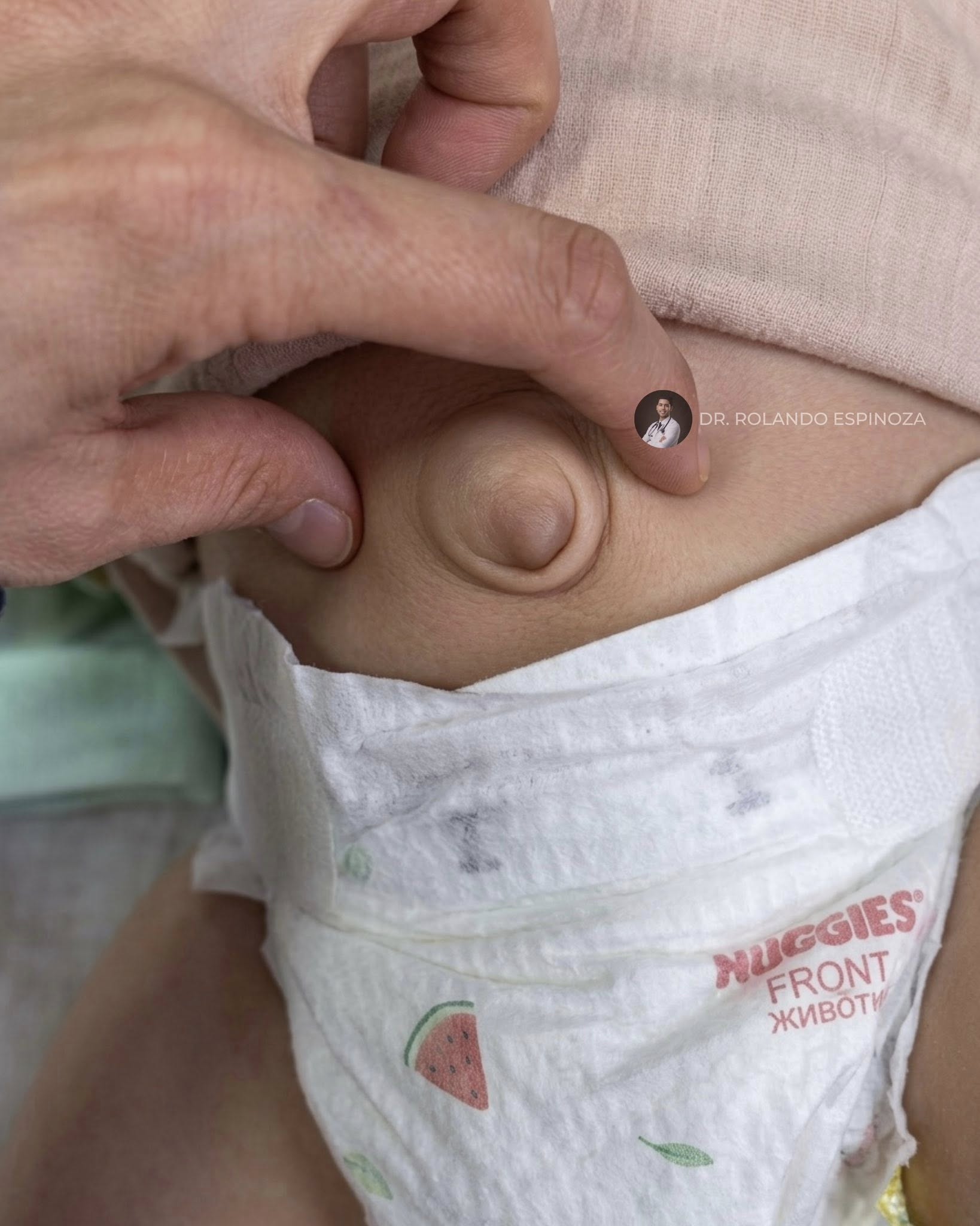 肚臍凸凸的!醫生驚見寶寶「肚臍被貼硬幣24小時」 長輩說能壓平「醫揭恐怖後果」氣炸