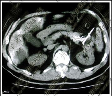 天天自己煮口味清淡!一家3口「接連罹胰臟癌」 醫追查元兇竟是「每天早餐喝的餛飩湯」
