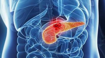 天天自己煮口味清淡!一家3口「接連罹胰臟癌」 醫追查元兇竟是「每天早餐喝的餛飩湯」