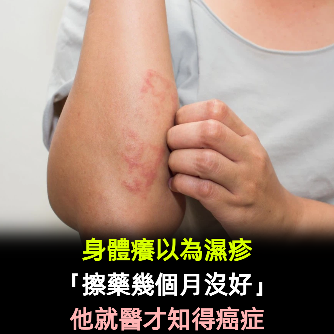 身體癢以為濕疹「擦藥幾個月沒好」！他就醫才知得癌症