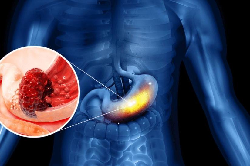 28歲女「脖子痛一週」以為扭到！　一檢查「竟是胃癌末期」醫嘆：80％早期無明顯症狀