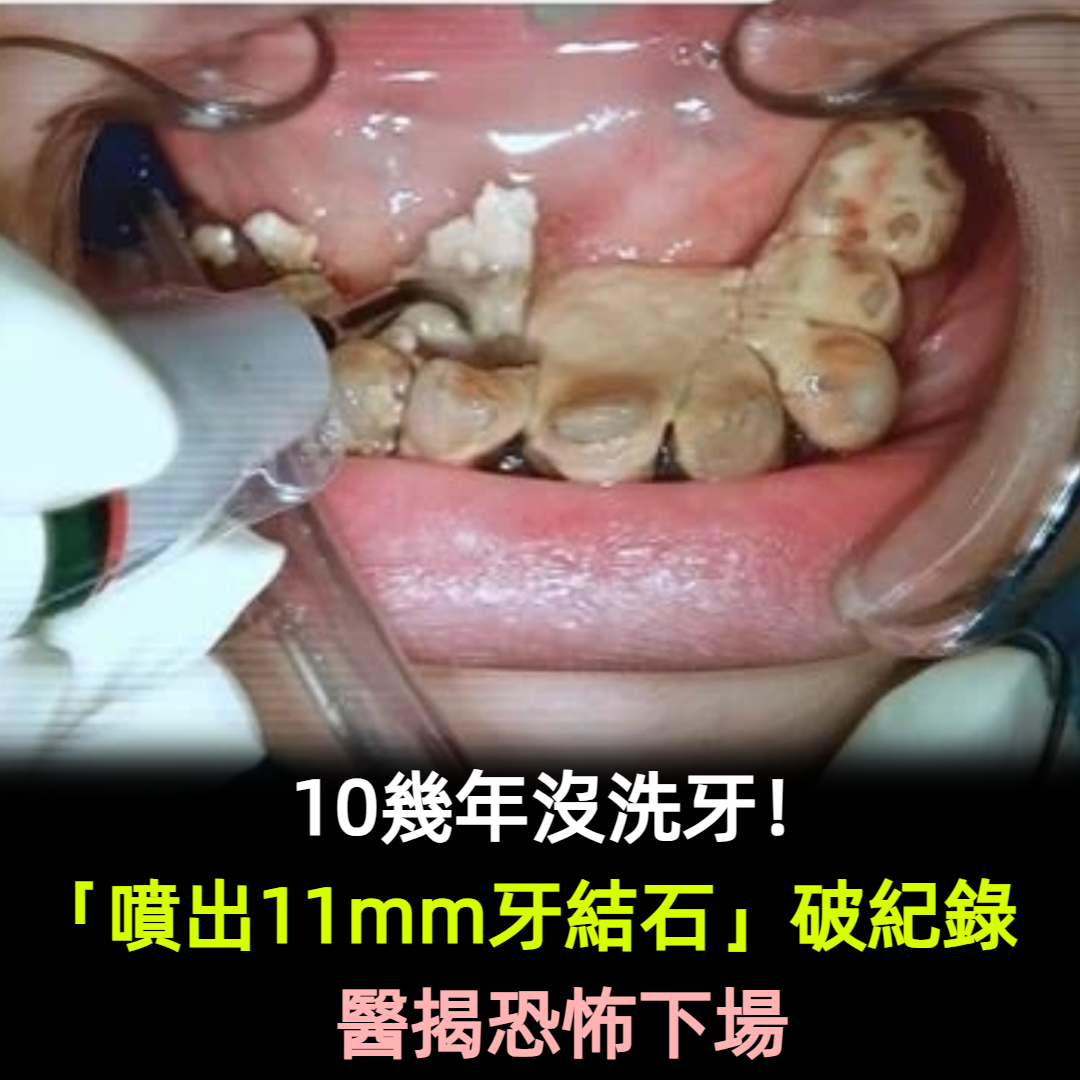 10幾年沒洗牙！「噴出11mm牙結石」破紀錄　醫揭恐怖下場