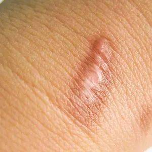 肚皮長痘痘！14歲弟弟「狂摳4個月」醫檢查嘆：是癌症