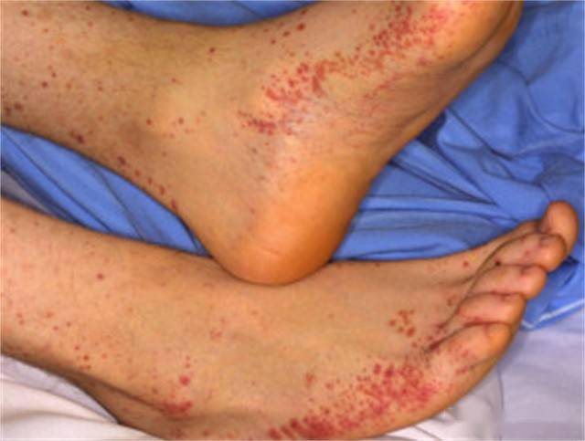 感冒好不了!醫見11歲弟「腳上密集紅點」喊快轉診 一驗父母心碎了