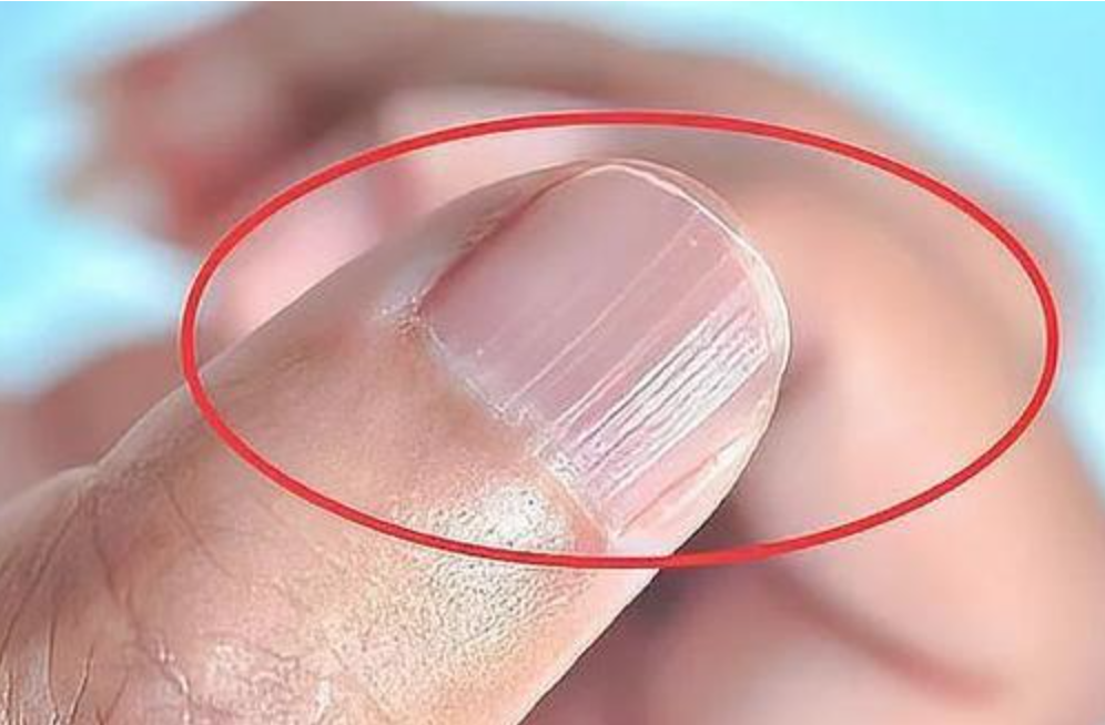 被嗆吃飽沒事幹!她發現「老公手指甲發紫」勸就醫遭拒 幾天後「尪突胸痛送醫」醫曝病況:再晚就慘了