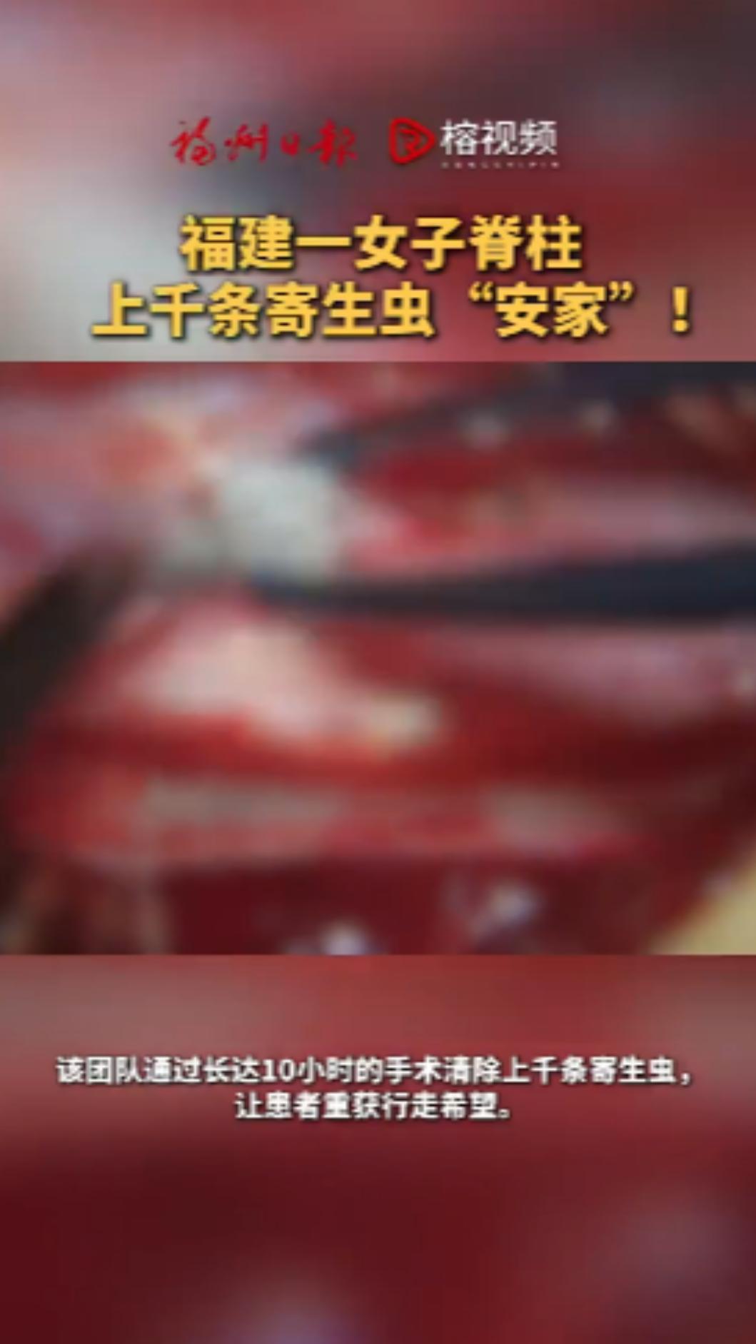 婦人腰腿「痛到快癱瘓」!醫生手術傻住:「像在湯裡撈麵條」