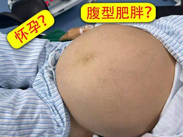 肚子腫成球!63歲婦人「懷胎」10年 醫師取出「整整11公斤巨型炸彈」腿軟:別以為是發福