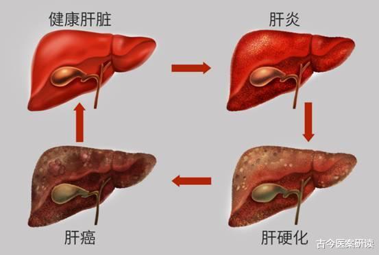 才剛結婚!28歲女「照出肝臟腫瘤」 醫一聽「每天喝一碗」搖頭:難怪壞了...