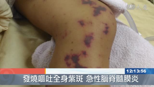 染腦脊髓膜炎隔天亡！醫示警「皮膚2異狀」快送醫：恐數小時內奪命