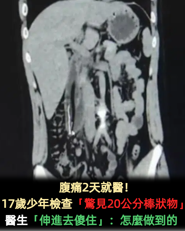 腹痛2天就醫!17歲少年檢查「驚見20公分棒狀物」 醫生傻眼:「怎麼吞下去的?」