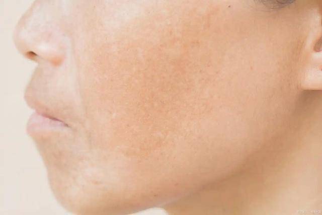 天氣熱要當心！出現3症狀「代表你中暑了」：嚴重恐器官衰竭