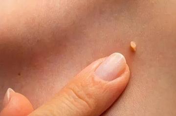 皮膚狂冒小肉芽別疏忽！醫揭「不是老化才會長」　示警「3症狀快就醫」：被一病找上了