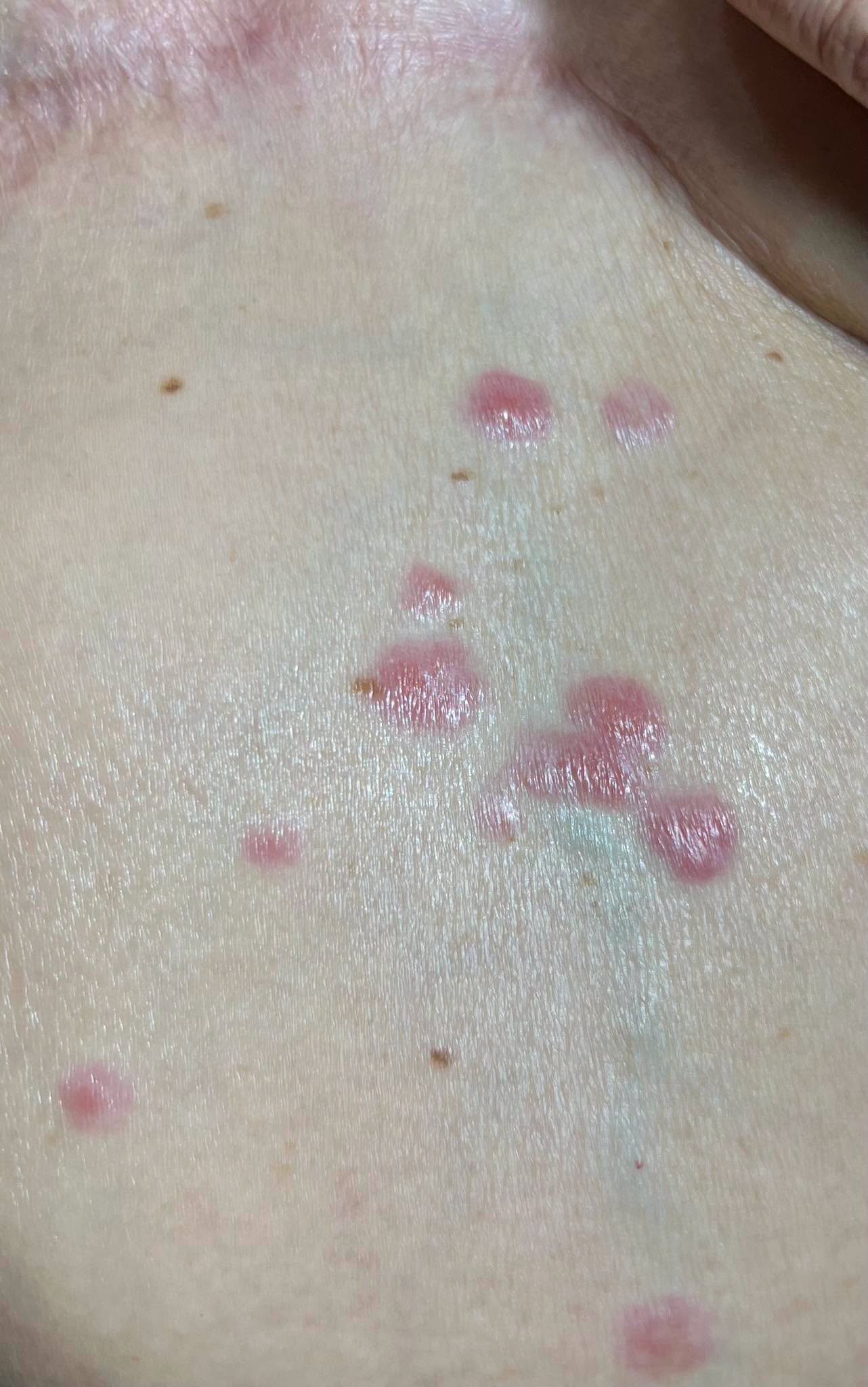 70歲婦人肚子冒紅疹「以為只是濕疹」! 醫生一看「癌症轉移了」:不痛不癢更危險