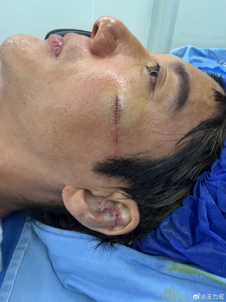 50歲金曲歌王出事!驚傳縫39針「耳骨撞碎」血流到脖子 首發聲說明狀況