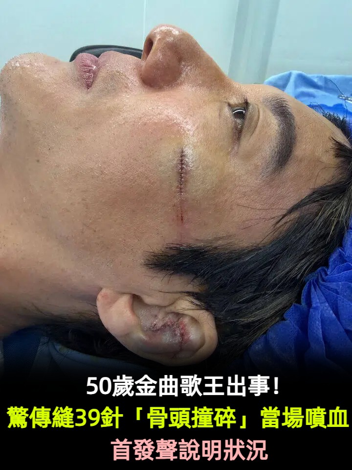 50歲金曲歌王出事!驚傳縫39針「耳骨撞碎」血流到脖子 首發聲說明狀況