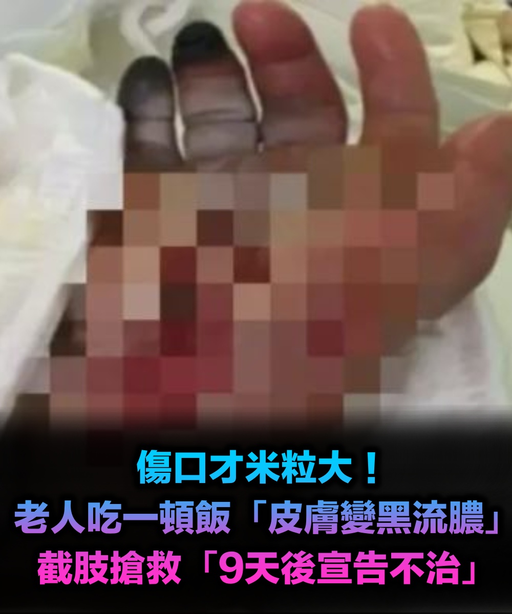 傷口才米粒大!老人不在意「皮膚變黑流膿」 不到24小時休克「截肢不治」