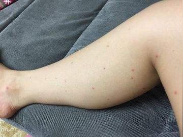 皮膚長出「小紅痣」只是正常老化!? 醫警告「一狀況快就醫」:是癌症信號!