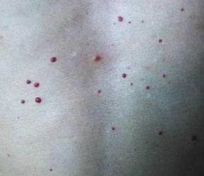 皮膚長出「小紅痣」只是正常老化!? 醫警告「一狀況快就醫」:是癌症信號!
