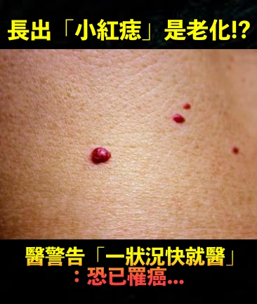 皮膚長出「小紅痣」只是正常老化!? 醫警告「一狀況快就醫」:是癌症信號!