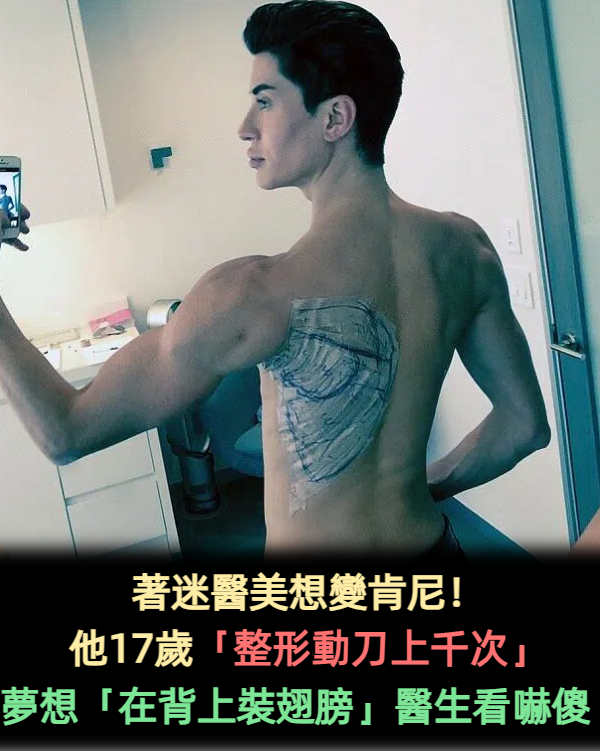 變身人間肯尼!男子著迷醫美「17歲就開始整形」動刀上千次 還曾請醫生幫他「在背上裝翅膀」
